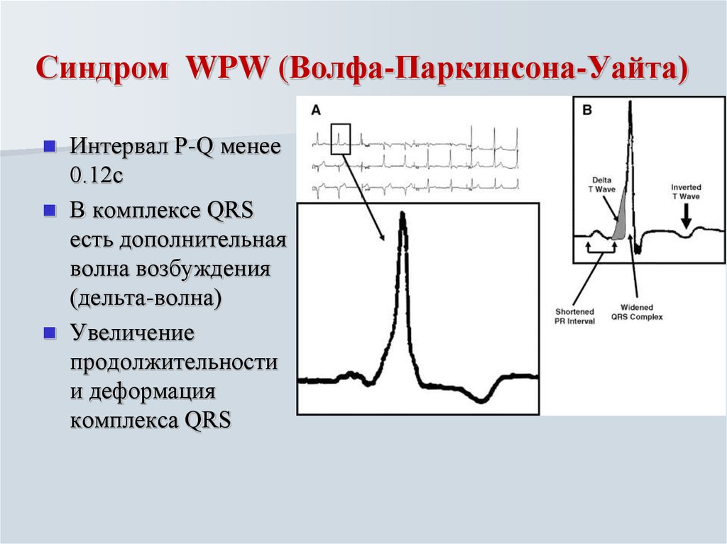 Wpw синдром на экг картинки