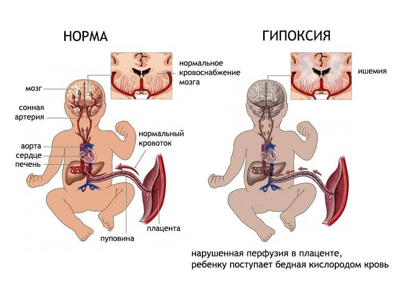 Тахикардия у детей