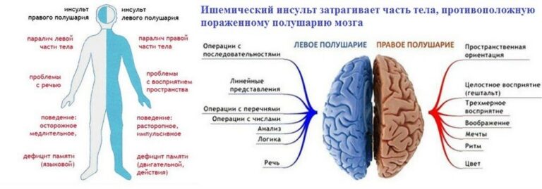 Ишемический инсульт и геморрагический инсульт картинки